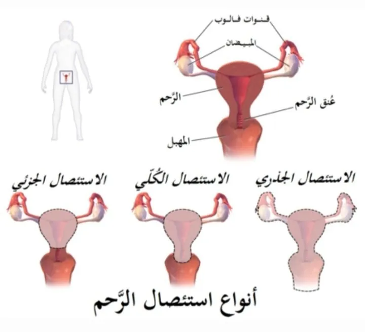 استئصال الرحم